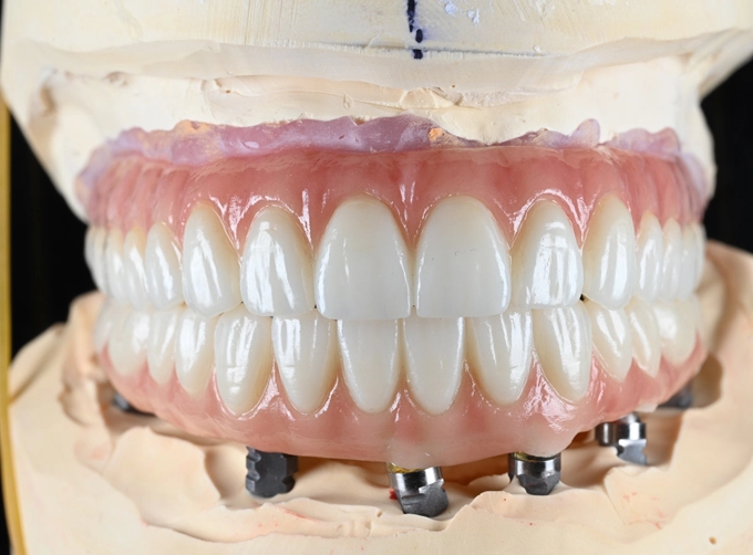 full arch zirconia implant bridge cost