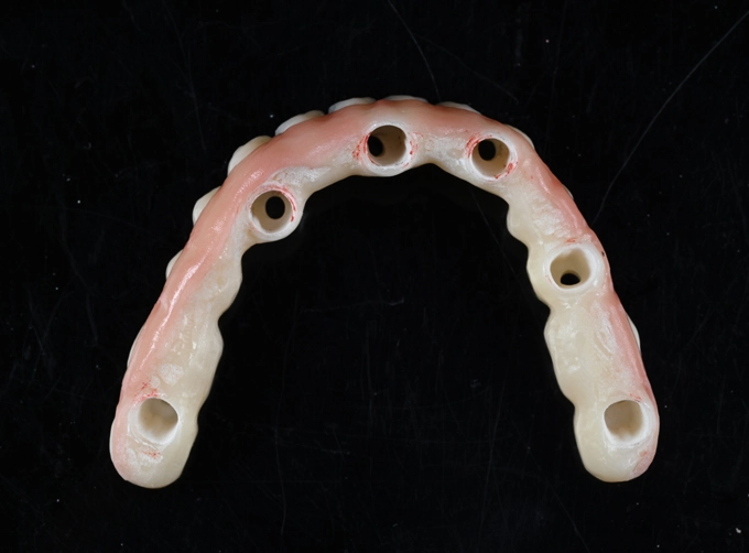 full arch zirconia implant bridge