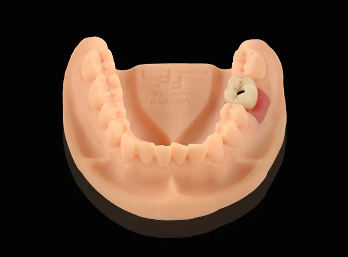 implant pfm crown