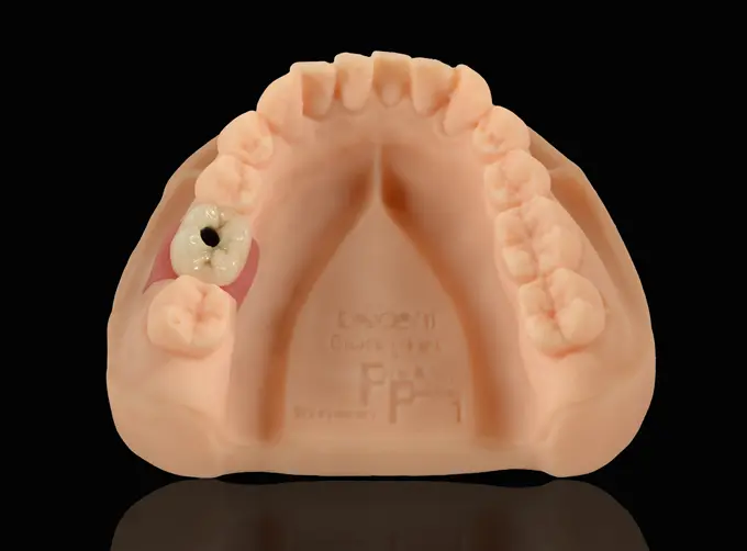 pfm implant crown