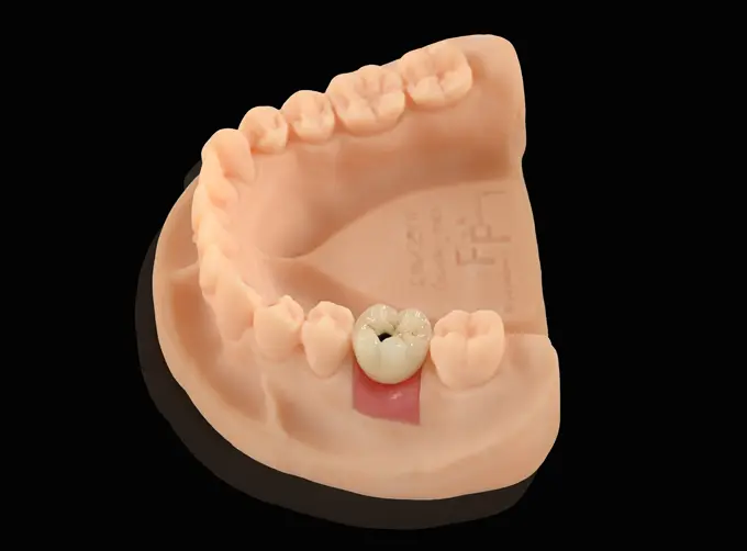 removable dental prosthesis