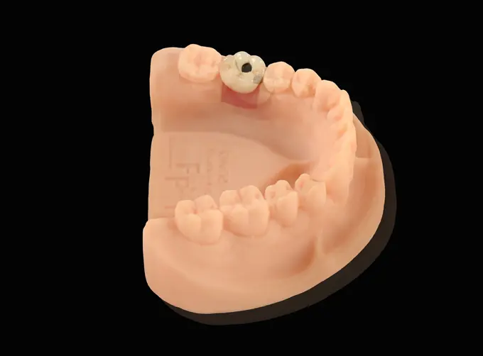 screw retained pfm implant crown