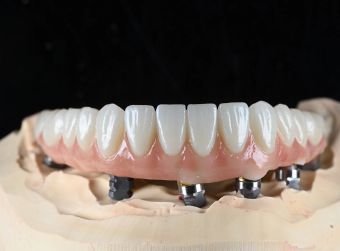 zirconia full arch cost