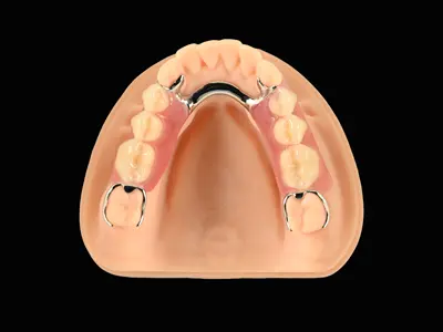 Printed Partial Framework - Co-Cr & Acrylic Partial Denture