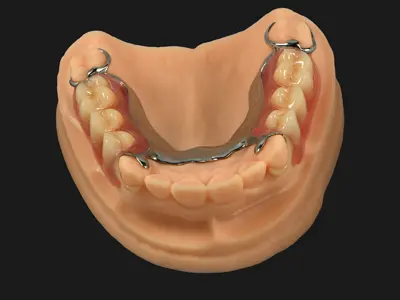 Printed Partial Framework - Co-Cr & Acrylic Partial Denture (Color Clasp)