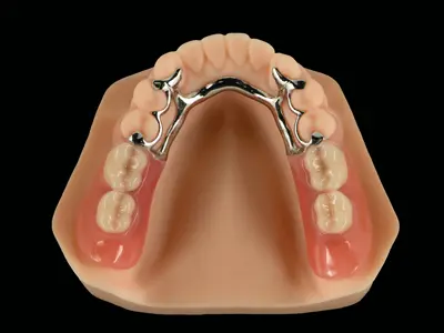 Printed Partial Framework - Co-Cr & Acrylic Partial Denture (Flexible Clasp)