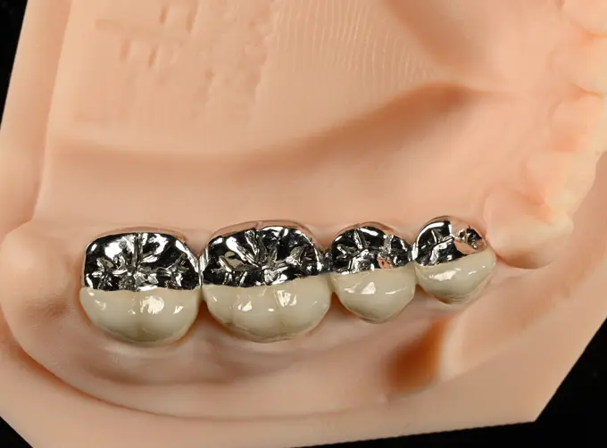 pfm dental bridge