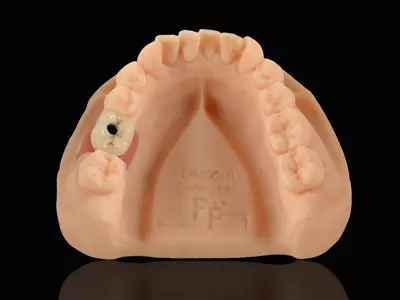 PFM Implant Crown -Co-Cr (Screw Retained)