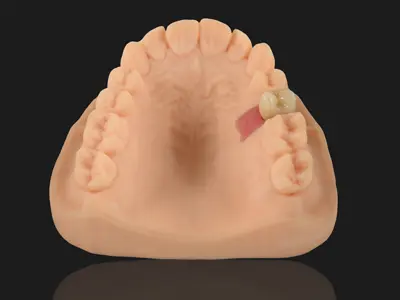 Zirconia Implant Crown (Cement Retained)