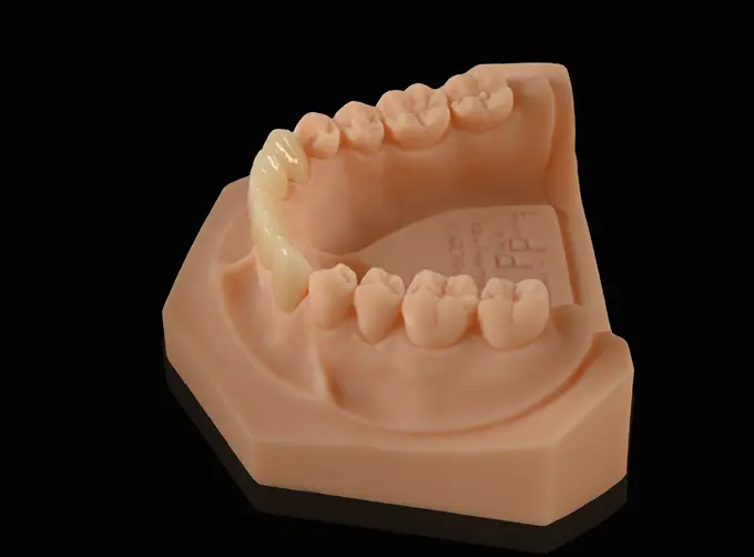 emax dental bridge