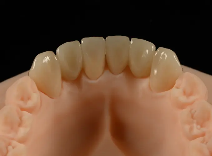 emax dental bridge