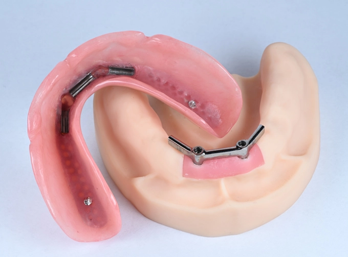 locator abutment impression coping