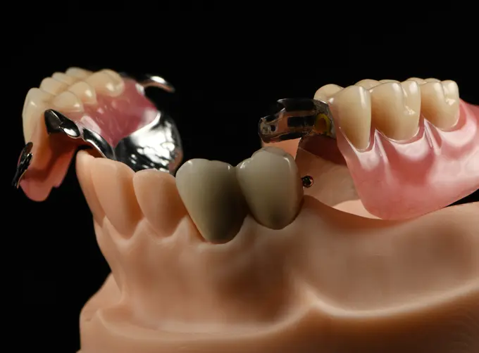 components of implants dental company