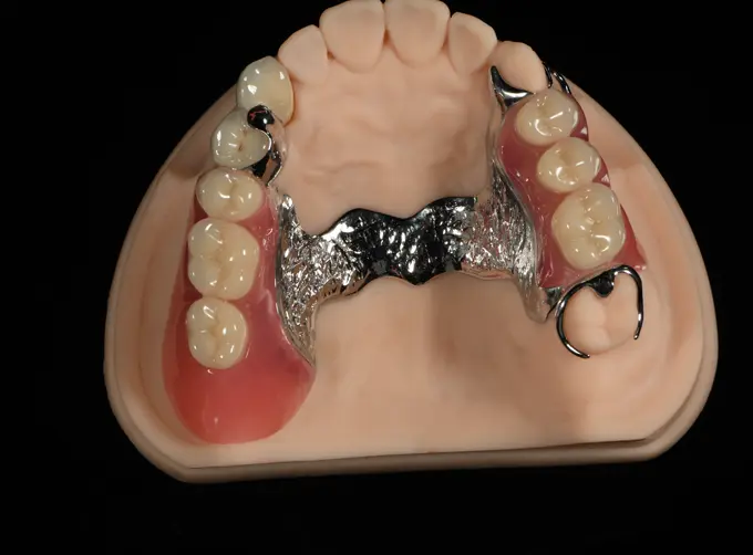 components of implants dental