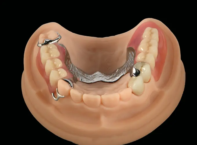 implant kit components