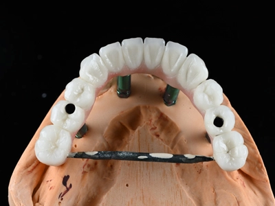 PFM Implant Bridge -Co-Cr (Screw Retained)