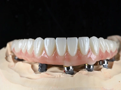 Full Zirconia Bridge (Multilayered+Screw Retained)